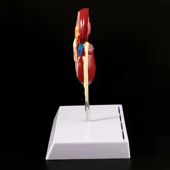 Gyvenimo Dydžio Žmonių Sergančių Inkstų Anatomijos Modelis Anatomija Ligonių Patologinių Akmens Organų Mokymo Reikmenys