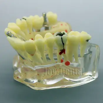 žmogaus modelis, Dantų implantai modelis Patologinių rodo, Burnos, dantų išsamią mokymo modeliai nemokamas pristatymas