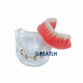 Dantis keičia apatinio žandikaulio modelio Overdenture implantas modelis dantų Protezų su aukso juosta Ortopedų studijų Modelis