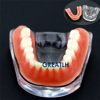 Dantis keičia apatinio žandikaulio modelio Overdenture implantas modelis dantų Protezų su aukso juosta Ortopedų studijų Modelis