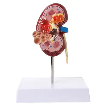 Gyvenimo Dydžio Žmonių Sergančių Inkstų Anatomijos Modelis Anatomija Ligonių Patologinių Akmens Organų Mokymo Reikmenys